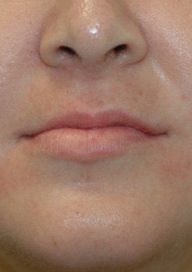 Lip Augmentation