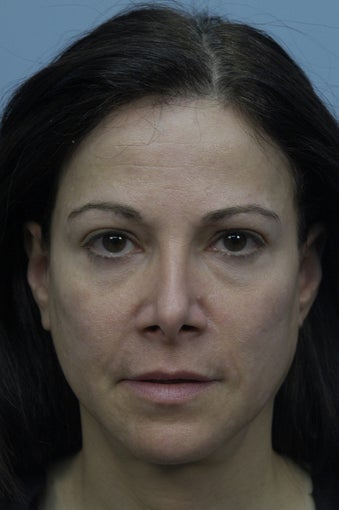 Filling under eye Hollows with Restylane