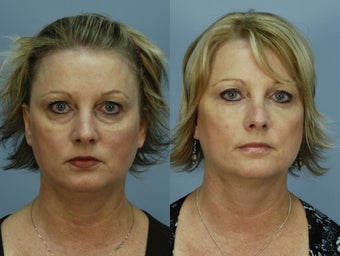 Restylane filling the under eye hollows VUE (tm)