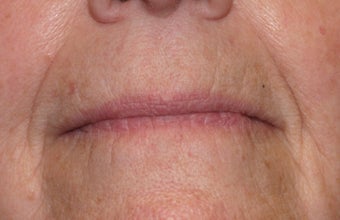 Restylane injection to nasolabial folds