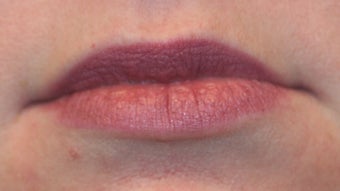 Restylane and botox used to augment the lips