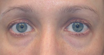 Restylane to tear trough deformity of lower lids