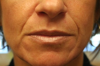 Radiesse and Restylane to the nasolabial folds