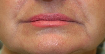 Restylane around the mouth