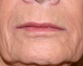 Restylane filler to the lips