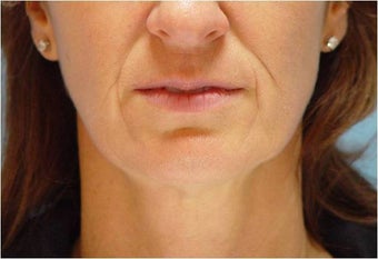 Restylane in Nasolabial folds and Marionette lines