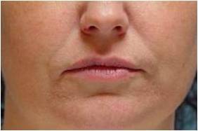 Lip augmentation