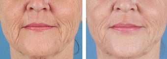 Dermal Filler to Wrinkles