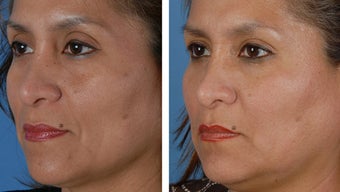 Filler injections to the cheek folds
