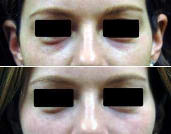 Filling of under-eye hollows / tear troughs with hyaluronic acid filler