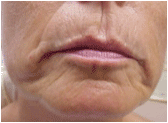 Restylane