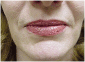 restylane 