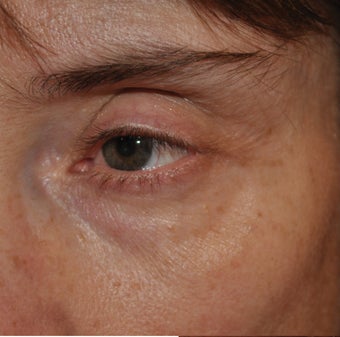 Restylane Injection into the Tear Troughs