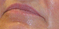 Restylane