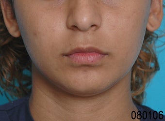 Lip Augmentation