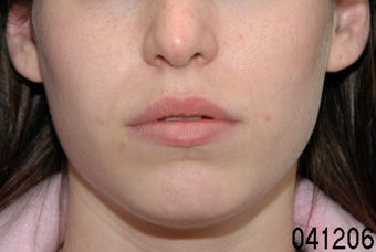 Lip Augmentation