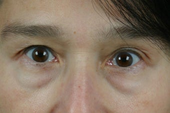 Restylane to Tear Trough