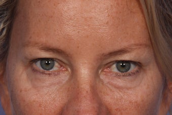Restylane to Tear Trough (under eyes)