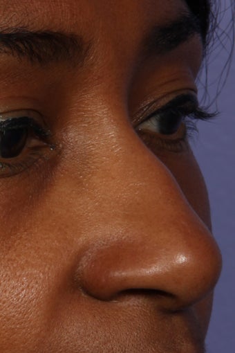 Restylane - Nose