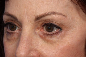 Restylane 