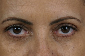Restylane 