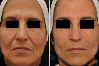Restylane and Botox