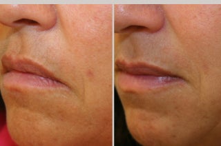 Restylane