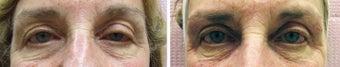 Eye Rejuvenation Restylane