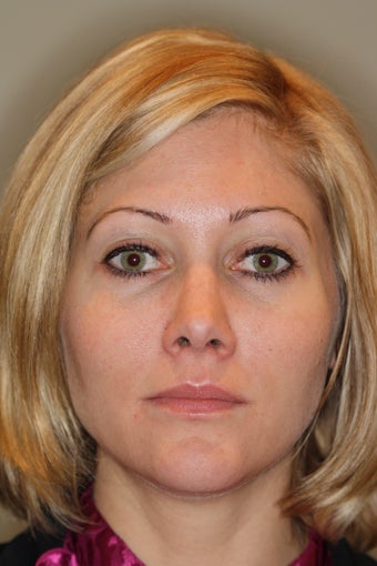 Restylane to Lips