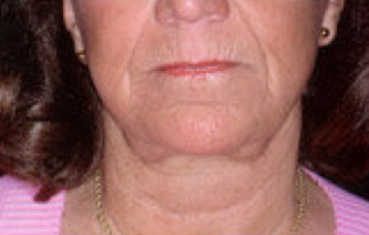 Extreme filler a.k.a liquid facelift