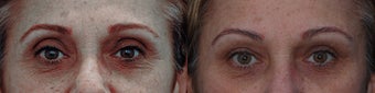 Upper eyelid filler with restylane