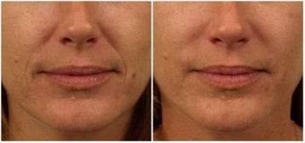 Restylane