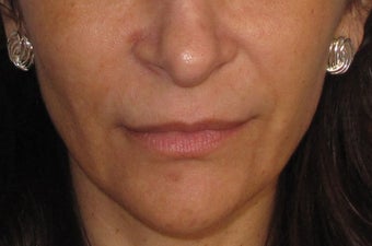 Restylane