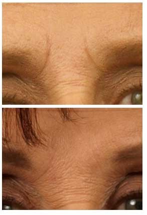 Restylane