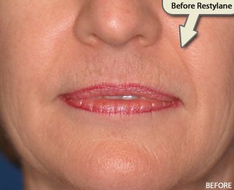 Restylane FIller Augmentation of the Nasolabial Folds