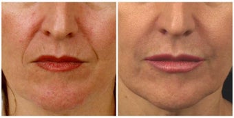 Restylane