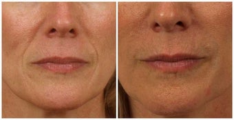 Restylane