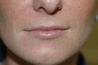 Lip augmentation
