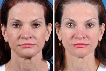 Fillers and Botox Cosmetic