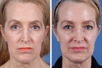 Restylane and Botox Cosmetic