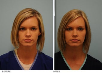 Facial Fillers for cosmetic Enhancement