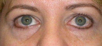 Restylane for eyes