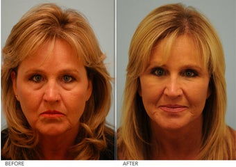 Restylane