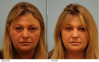 Restylane and Short Term Botox