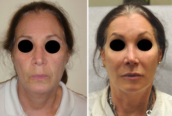 Facial Rejuvenation with Filler
