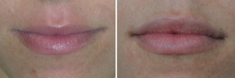 Lip Augmentation