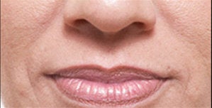 Restylane®