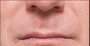 Restylane®