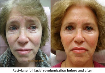Restylane full facial rejuvenation