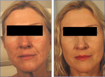 Restylane for Laugh Lines Before and After Photo